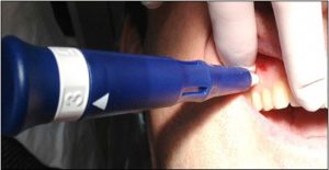 کاهش طول درمان ارتودنسی