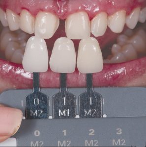 دیاستم یا فاصله بین دندان ها