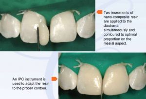 دیاستم یا فاصله بین دندان ها
