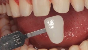 دیاستم یا فاصله بین دندان ها