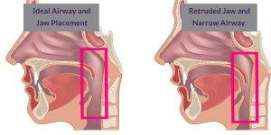 مجرای تنفسی و درمان ارتودنسی