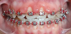 سفید نگه داشتن دندان در طول ارتودنسی