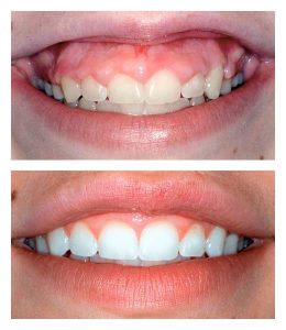 لیفت یا کانتور لثه