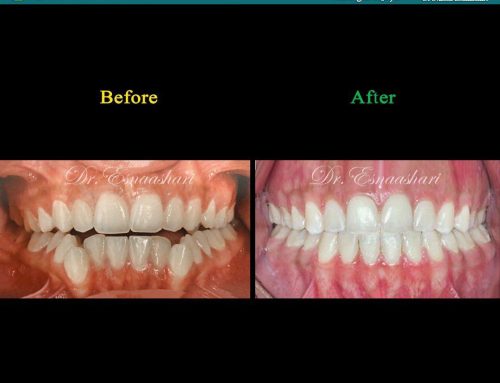 قبل و بعد از درمان ارتودنسی ثابت اصلاح اپن بایت