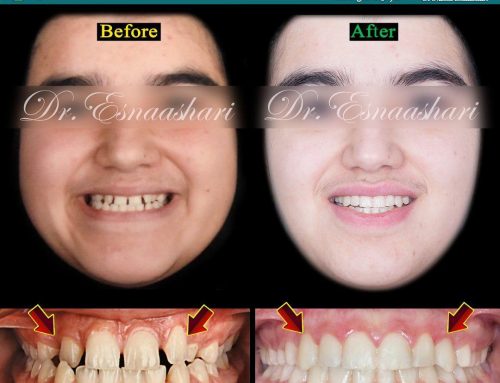 قبل و بعد از درمان ارتودنسی دندان نیش