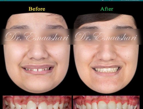 قبل و بعد از درمان ارتودنسی اصلاح عقب رفتگی فک