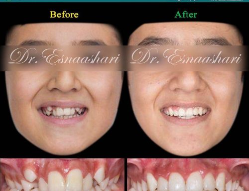 قبل و بعد از درمان ارتودنسی فانکشنال