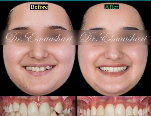 قبل و بعد از درمان ارتودنسی اصلاح خط لبخند