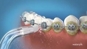 نخ دندان کشیدن در ارتودنسی
