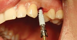 ایمپلنت های دندانی
