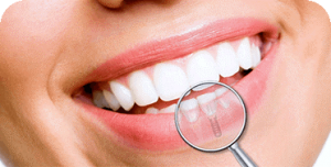 ایمپلنت های دندانی