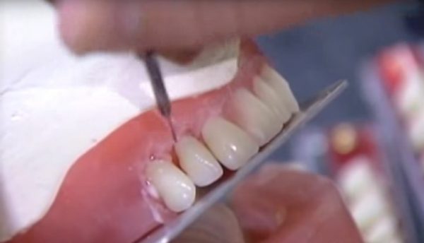 پروتز دندانی دندان مصنوعی