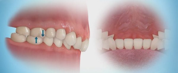 دیپ بایت درمان دیپ بایت