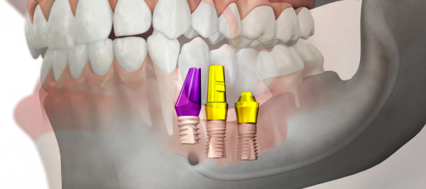 ایمپلنت های دندانی