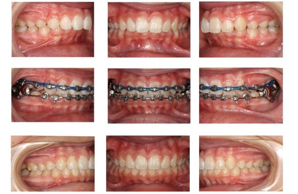 دیپ بایت درمان دیپ بایت