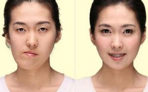 درمان عدم تقارن صورت با اصلاح لبخند