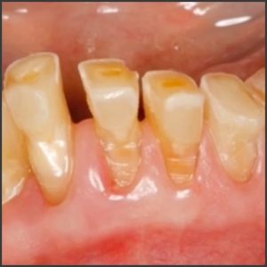 تاثیر دندان قروچه بر ارتودنسی