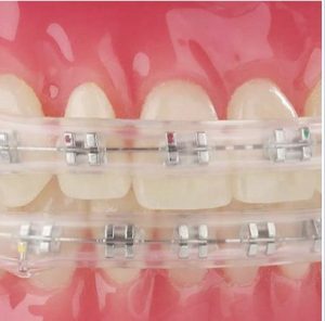 درمان زخم ارتودنسی