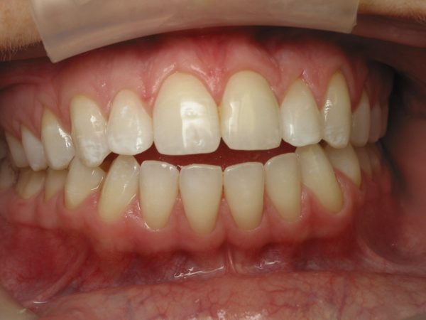 تانگ تراست یا فشار زبان پشت دندانها