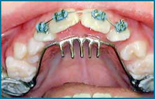 تانگ تراست یا فشار زبان پشت دندانها