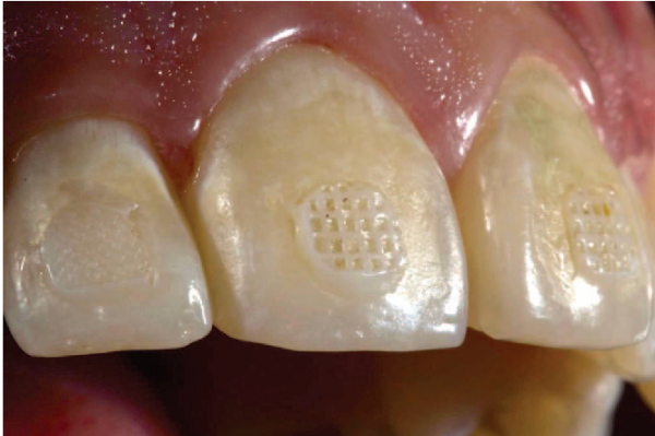 برداشتن براکتهای ارتودنسی (دیباندینگ)