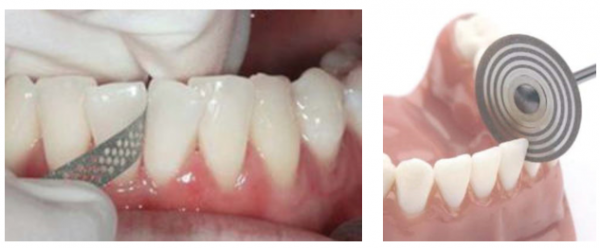 حساسیت دندان در ارتودنسی