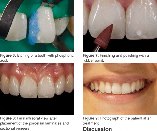 ونیر و لمینت دندان