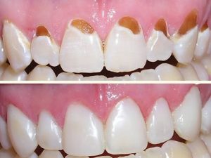 ونیر و لمینت دندان