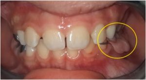 کیست با منشاء دندانی یا دنتی ژورس