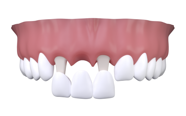 بریج دندانی