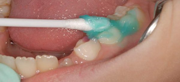 مزایای وارنیش فلوراید