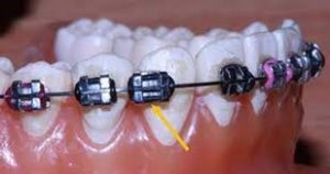 شل شدن بند ارتودنسی