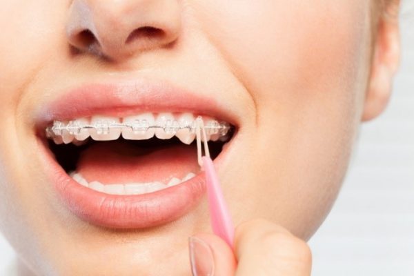 رابر بند ارتودنسی