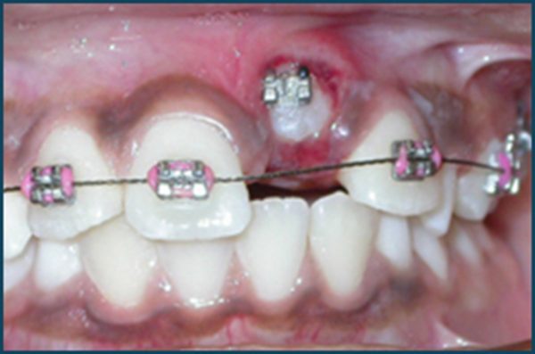 اثر داروها بر ارتودنسی