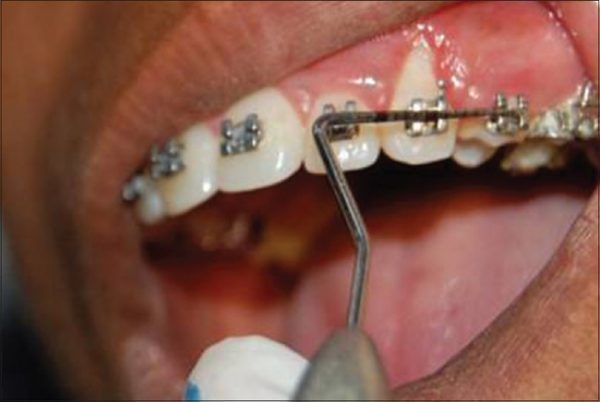 اثر داروها بر ارتودنسی