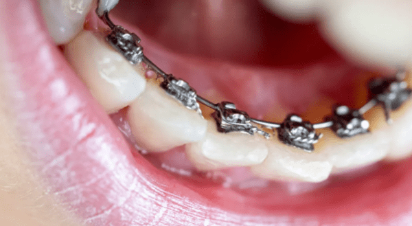 مزه فلز داخل دهان