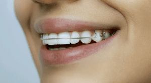 صاف کرد دندان ها بدون ارتودنسی سنتی