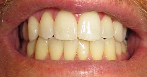 کریز لاین روی دندان