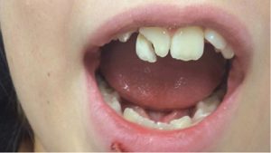 تروما یا حوادث دندانی