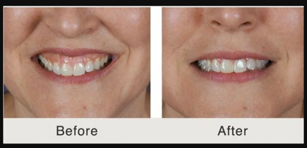 بوتاکس در دندانپزشکی