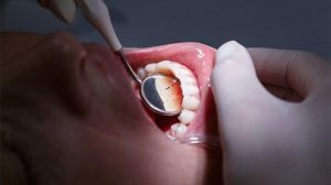 علائم پوسیدگی دندان