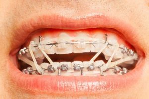 فلر شدن دندان بعد از ارتودنسی