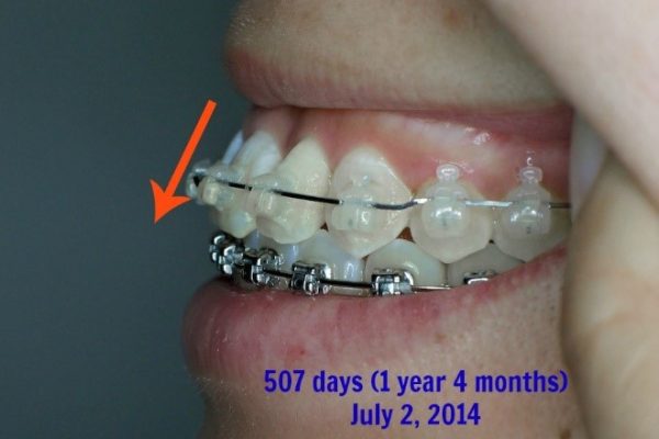 فلر شدن دندان بعد از ارتودنسی