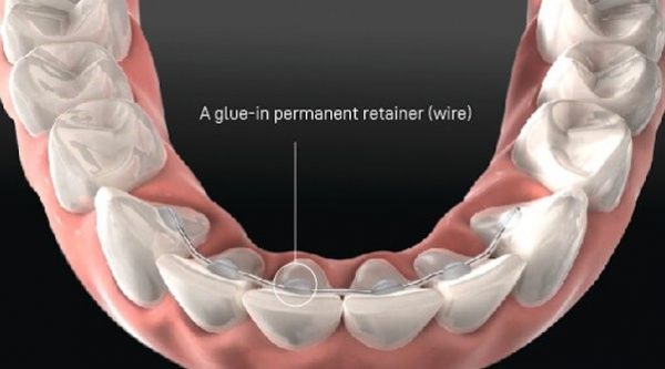 فلر شدن دندان بعد از ارتودنسی