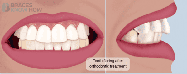 فلر شدن دندان بعد از ارتودنسی