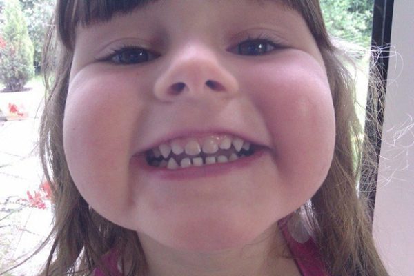  از دست رفتن دندان در کودکان