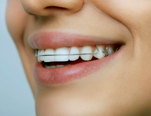 آیا ریتینرها واقعاً می توانند دندان ها را مرتب کنند؟