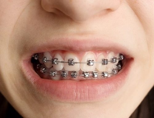 آیا با بریس ها می توان دهان را راحت بست؟