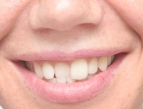 چرا در برخی افراد دندان های صاف به تدریج کج می شوند؟